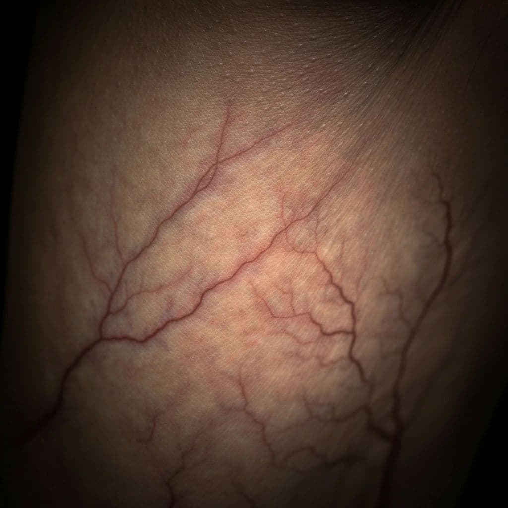 Spider Vein Removal